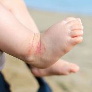 Atopowe zapalenie skóry u dziecka – jak łagodzić?