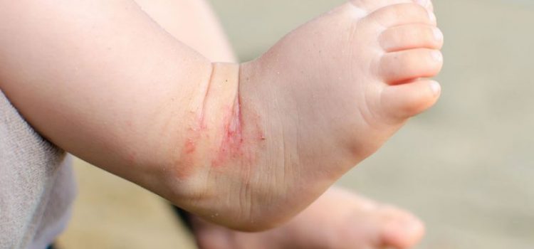 Atopowe zapalenie skóry u dziecka – jak łagodzić?
